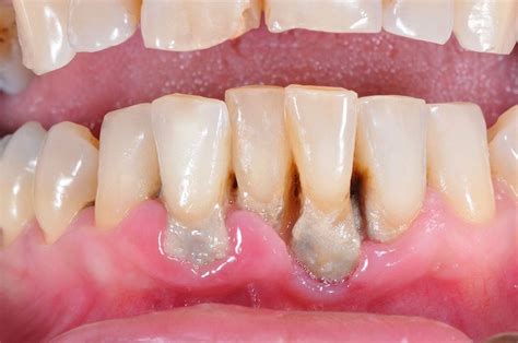 Periodontitis: síntomas, tratamiento y contagio - Directorio Odontológico