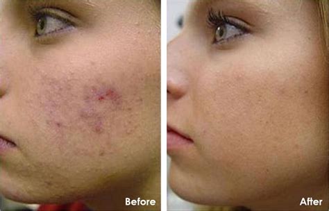 Light Tca Peel Before And After | edu.svet.gob.gt