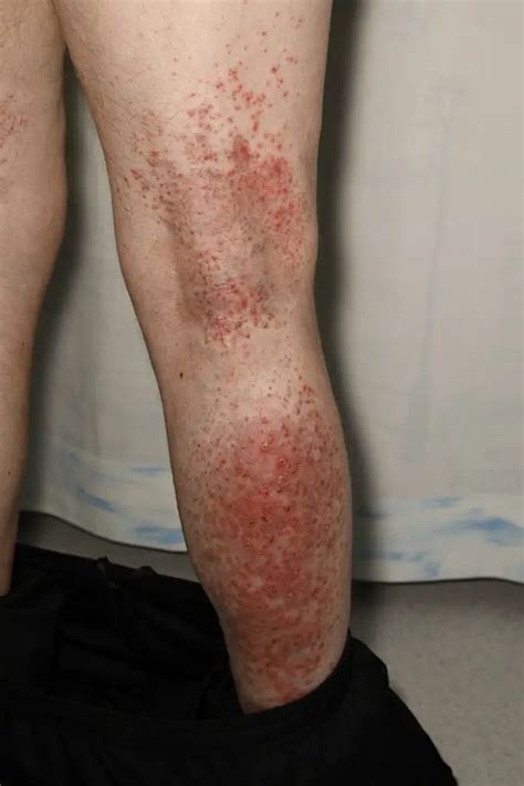 Rash After a Total Knee Replacement - What to Know - Best Physical Therapy Product Reviews