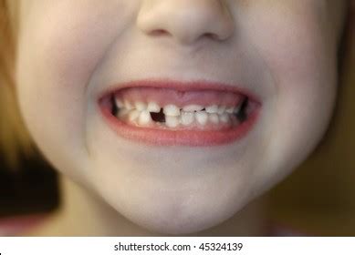 Closeup Little Girl Missing Teeth Stock Photo 45324139 | Shutterstock