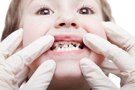 What is Baby Bottle Tooth Decay? - Pediatric Dentistry Orange Park Dr. Beth Kailes