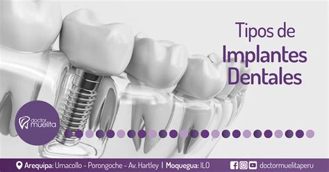 Tipos-de-Implantes-Dentales - Clínica Doctor Muelita