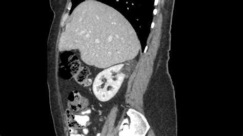 Renal Angiomyolipoma - Manal's Classroom