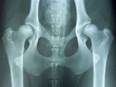 Congenital Hip Dislocation: Causes, Symptoms, and Diagnosis