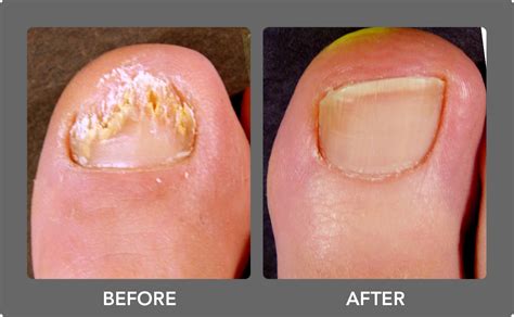 Toenail Fungus Laser Treatment | Boca Raton Podiatrist