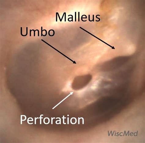 Perforation of the Tympanic Membrane - WiscMed