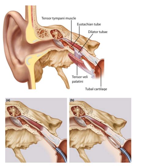 Auditory Tube BET Ear Pressure Balloon Eustachian Tuboplasty For Clinial