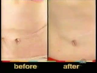 The Titan Skin Tightening | Medispa offers Titan Skin tightening, laser skin tightening ...