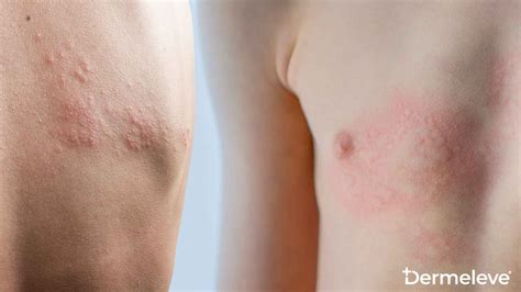 Hives vs Rash: How to Tell The Difference – Dermeleve®