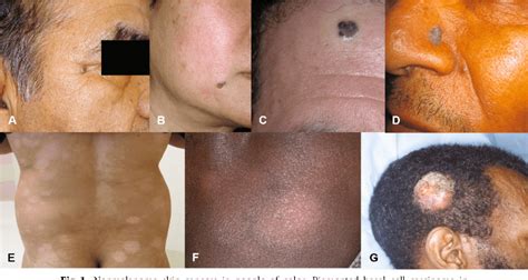 Skin Cancer In Patients Of Color