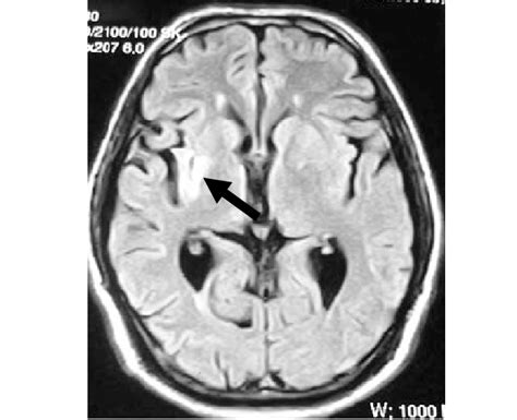 b. FLAIR MRI image at 6 months showing small residual encephalomalacia... | Download Scientific ...