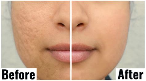 Large Pores Before And After