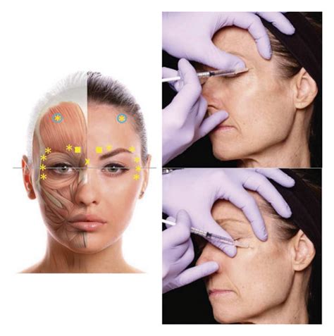 Botox was injected into five eyebrow areas and eight crow’s feet (four... | Download Scientific ...