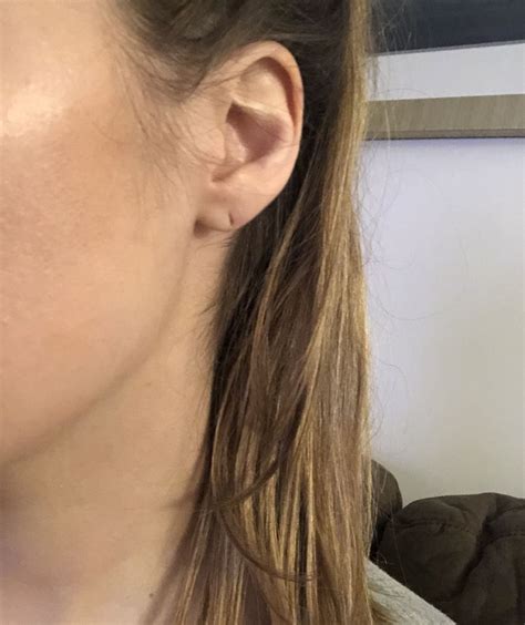 Stretched Earlobe Repair Surgery: Everything to Know