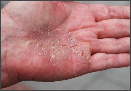 Psoriasis on hands pictures | Psoriasis expert