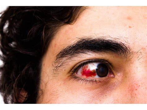 Blood in the Eye - Consumer Health News | HealthDay