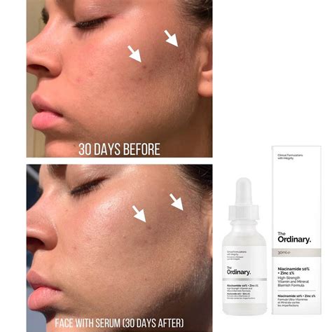 The Ordinary Niacinamide Review | Anti-Acne Serum | Beauup.com