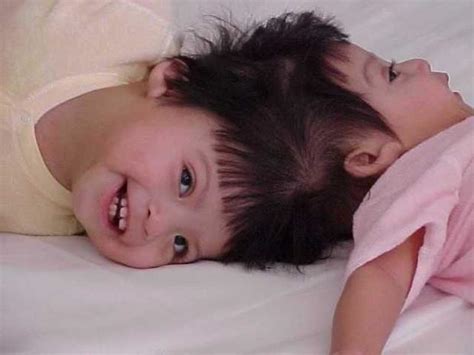 Conjoined twins (WARNING: GRAPHIC IMAGES) - CBS News