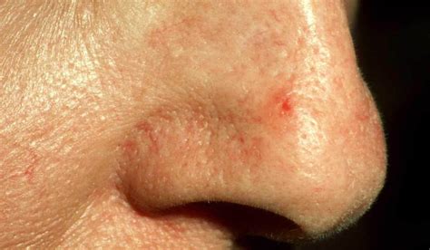 Red Spot Skin Cancer On Nose