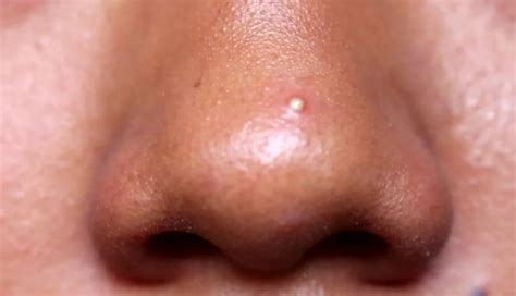 6 DIY Ways To Treat Pimples on Nose - lifeberrys.com