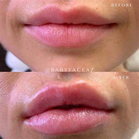 The most sexy Lip Fillers in Scottsdale - BabyFace MedSpa — Top Rated Scottsdale Med Spa | Babyface