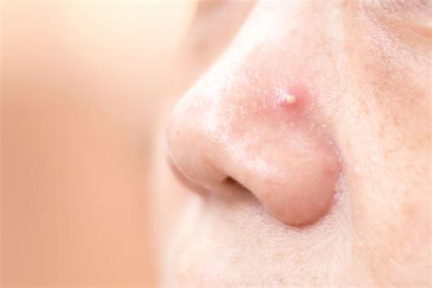 Nose Pimple: The Do's and Don'ts of Dealing with This Condition