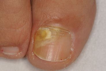 Proximal Subungual Onychomycosis | Plastic Surgery Key