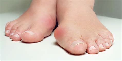 Deformities | Benenati Foot and Ankle Care Centers