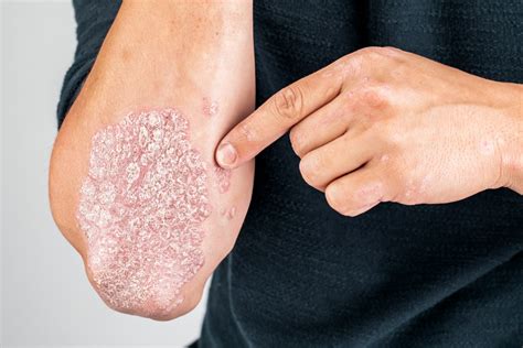 Psoriasis/Schuppenflechte - Ihr Hautarzt Wien