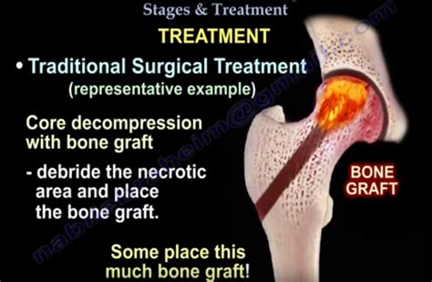 Avascular Necrosis of Hip- Stages — OrthopaedicPrinciples.com