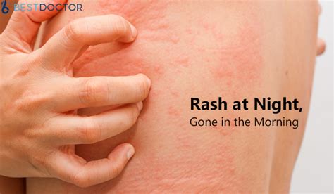 Rash at Night, Gone in the Morning? Why it Happens?