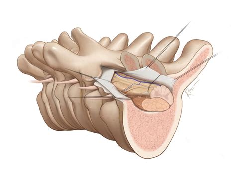 Meningioma Surgery | Expert Surgeon | Aaron Cohen-Gadol, MD