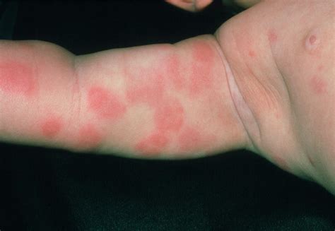 Food Allergy Skin Rash Baby
