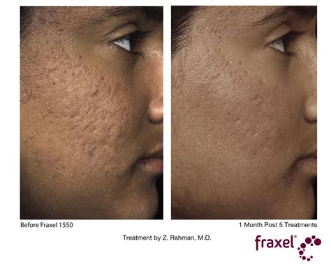 Fraxel Laser Before And After Dark Skin - change comin