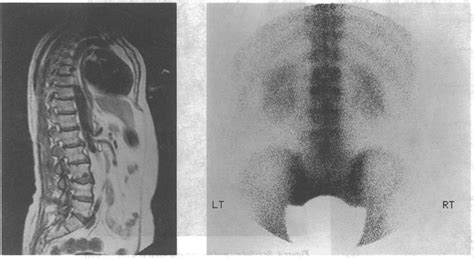 This patient with prostate cancer had a normal bone scan and a raised... | Download Scientific ...