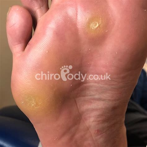 Corns | Skin problems | What We Treat | Chiropody.co.uk | Leading ...