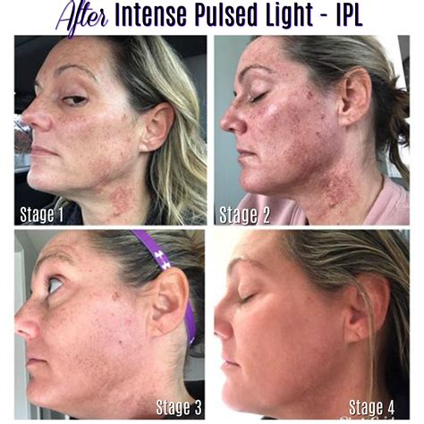 Skin Changes After Intense Pulsed Light – IPL – Charmed Medispa