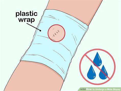 3 Ways to Undergo a Mole Biopsy - wikiHow Health