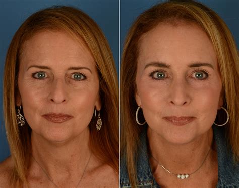 The UpLift™ Lower Face and Neck Lift Photos | Naples, FL | Patient 14192