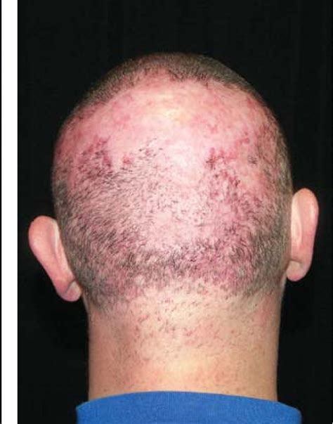 Chronic Scalp Folliculitis