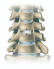 Cost of Cervical Disc Replacement Surgery in India from Top Hospitals and Doctors