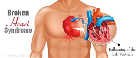 Broken Heart Syndrome | Takotsubo Syndrome (TTS) - Causes, Symptoms, Diagnosis & Treatment