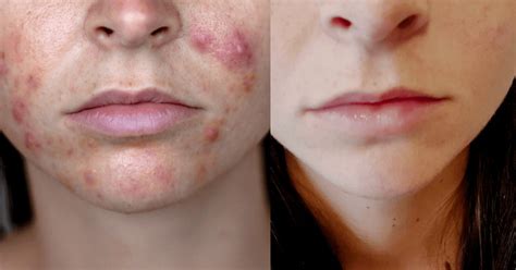 Spironolactone for acne: Complete guide + my experience