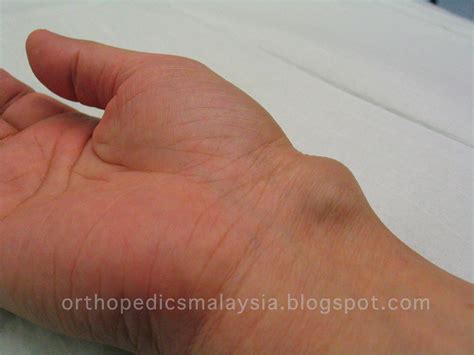 GANGLION CYST - swelling in the wrist | The Orthopedics Malaysia blog