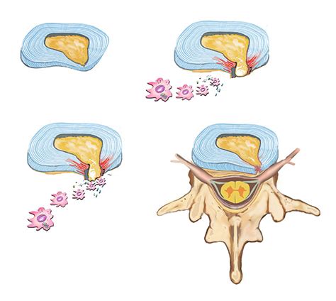 Chiropractic Treatment for a Thoracic Disc Herniation | Circle of Docs