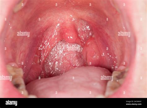 Tonsillitis. Swollen left tonsil (on right) of a 24 year old male patient with tonsillitis ...