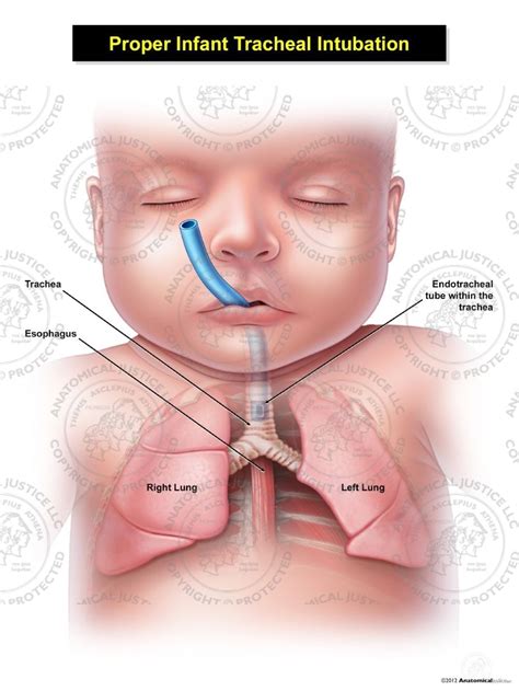 Proper Infant Tracheal Intubation