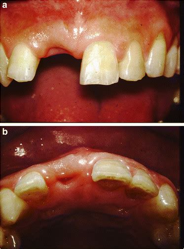 After the extraction of the maxillary central incisor (a frontal view,... | Download Scientific ...