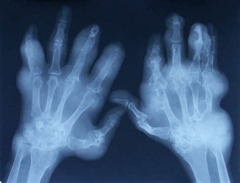 Bone Loss : Signs, Symptoms and Prevention - Sound Health Doctor