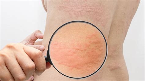 Cold urticaria: Symptoms, and Treatment | News Makhani | Latest ...